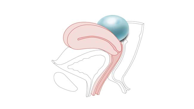 The Ovarian Cyst Multiparous Cervix works with the Standard and Advanced Limbs & Things CFPT Mk3 Trainer.