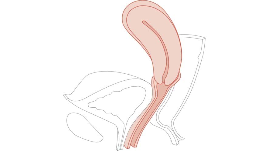 The Retroverted Uterus Multiparous Cervix works with the Standard and Advanced Limbs & Things CFPT Mk3 Trainer.