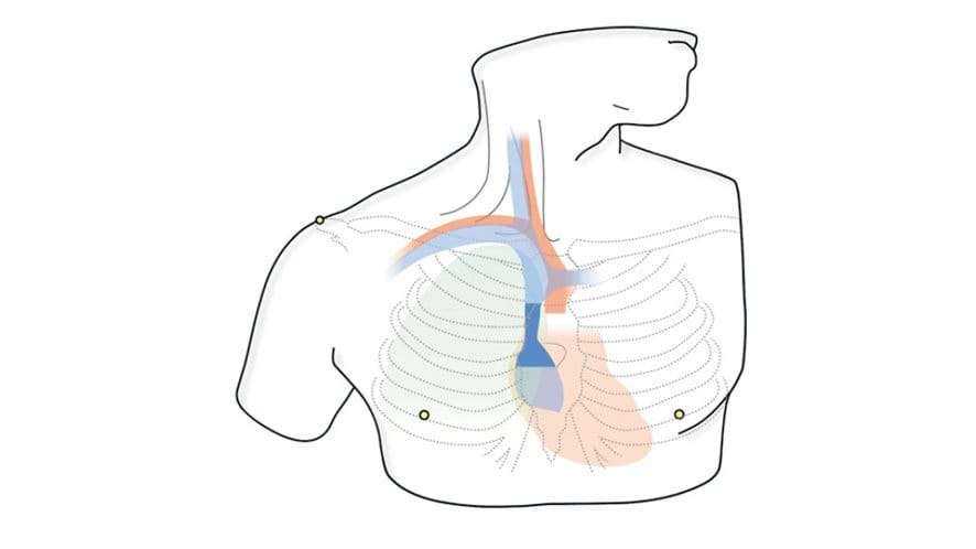 Internal jugular and subclavian (axillary) veins diagram of the CVC Insertion Simulator II 