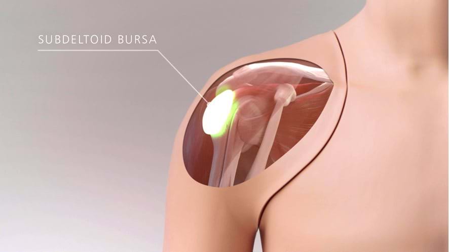 Subdeltoid Bursa of the Ultrasound guided Shoulder Injection Trainer in Light Skin Tone