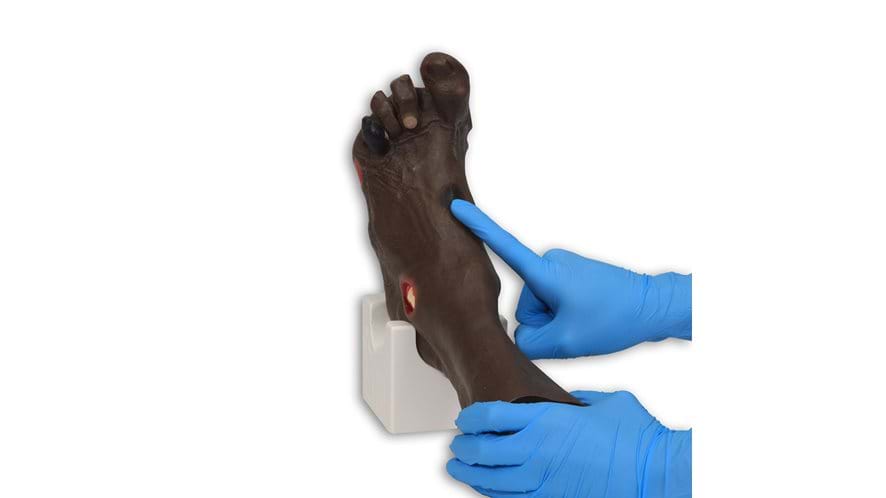 Wilma' Wound Foot™ with 20 conditions which allow for the identification & staging of wounds in dark skin tone