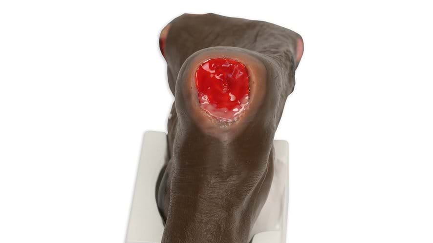 Stage 3 pressure ulcer on the heel of Wilma Wound foot in dark skin tone