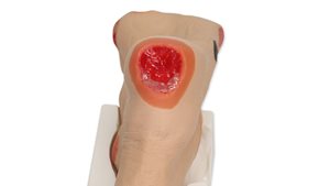 Stage 3 pressure ulcer on the heel of Wilma Wound foot